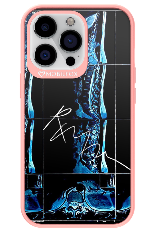 RMN Scolioza 2.0 - Apple iPhone 13 Pro