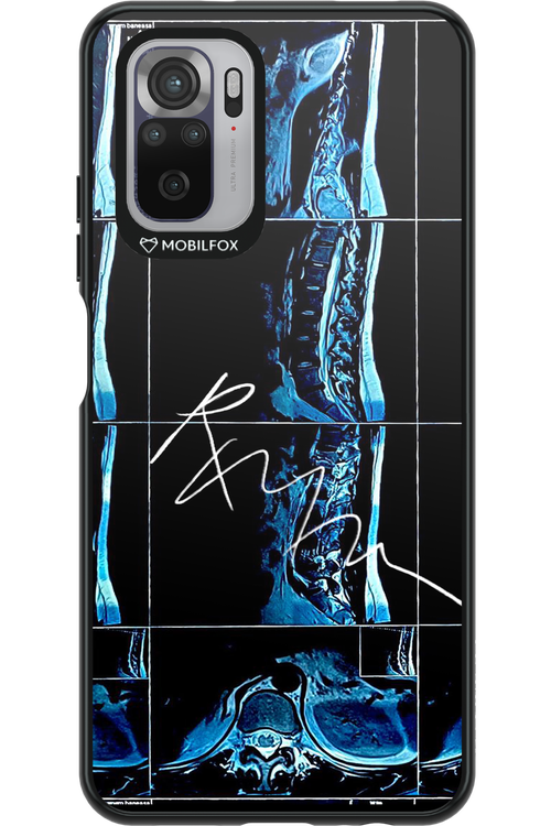 RMN Scolioza 2.0 - Xiaomi Redmi Note 10
