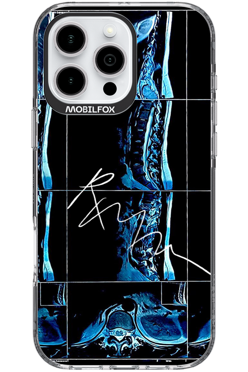 RMN Scolioza 2.0 - Apple iPhone 16 Pro Max
