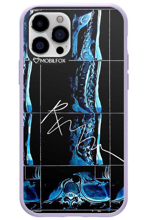 RMN Scolioza 2.0 - Apple iPhone 12 Pro