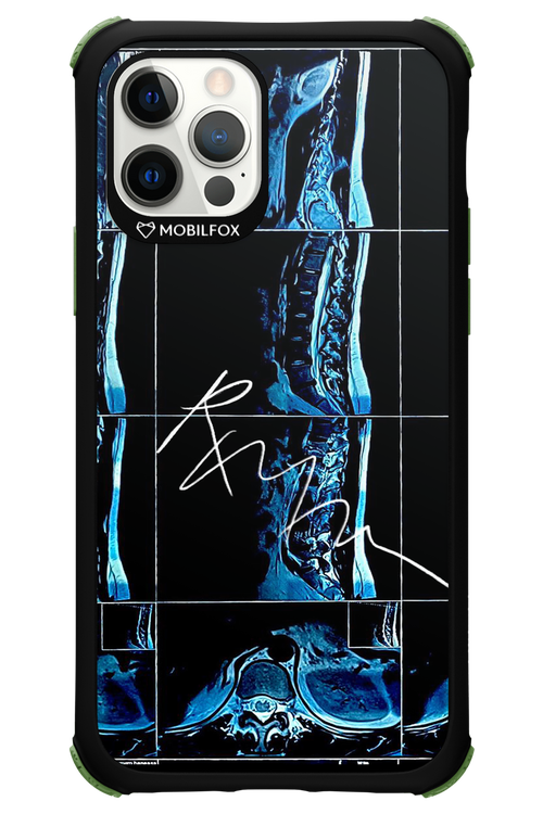 RMN Scolioza 2.0 - Apple iPhone 12 Pro