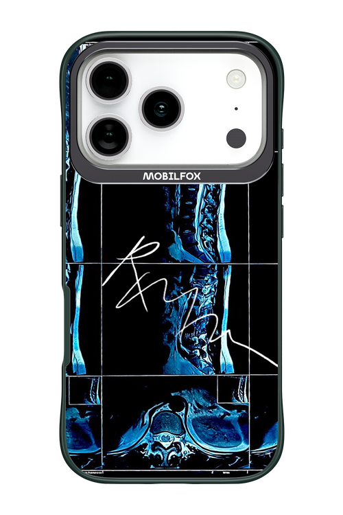 RMN Scolioza 2.0 - Apple iPhone 17 Pro