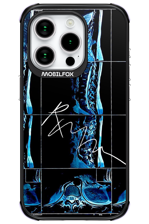 RMN Scolioza - Apple iPhone 15 Pro