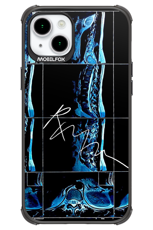 RMN Scolioza 2.0 - Apple iPhone 15 Plus