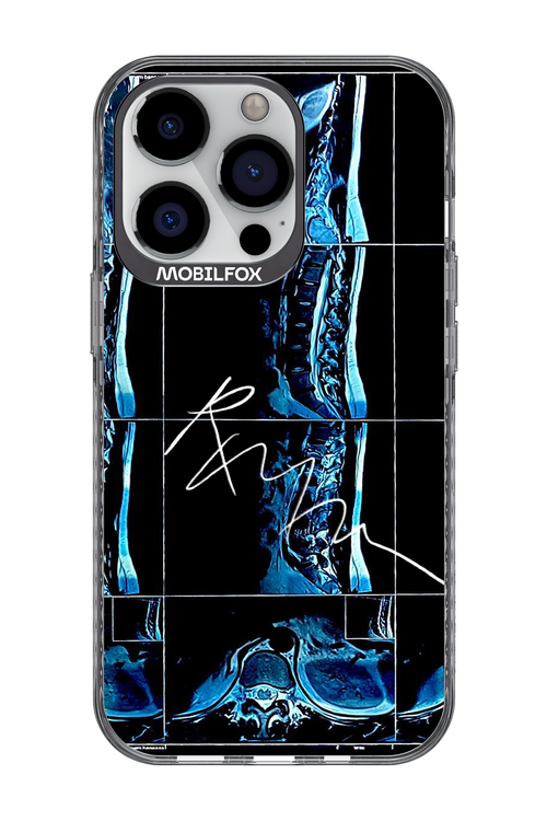 RMN Scolioza 2.0 - Apple iPhone 13 Pro