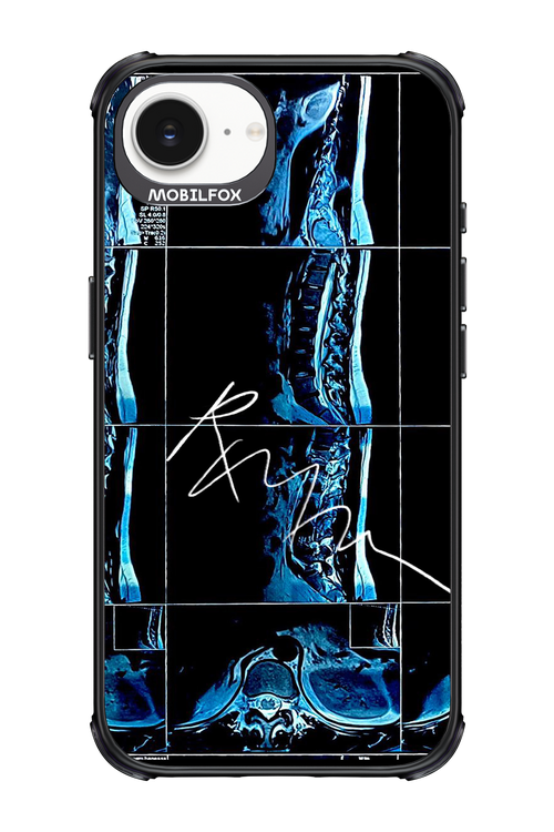 RMN Scolioza 2.0 - Apple iPhone 16e