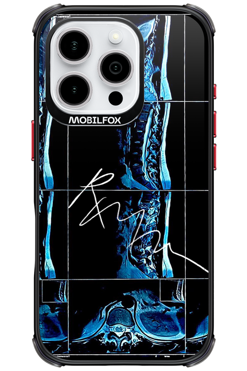 RMN Scolioza 2.0 - Apple iPhone 16 Pro