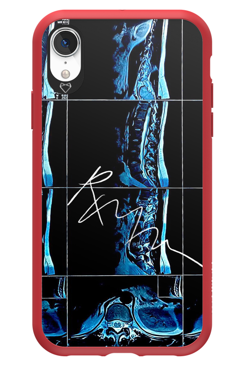 RMN Scolioza 2.0 - Apple iPhone XR