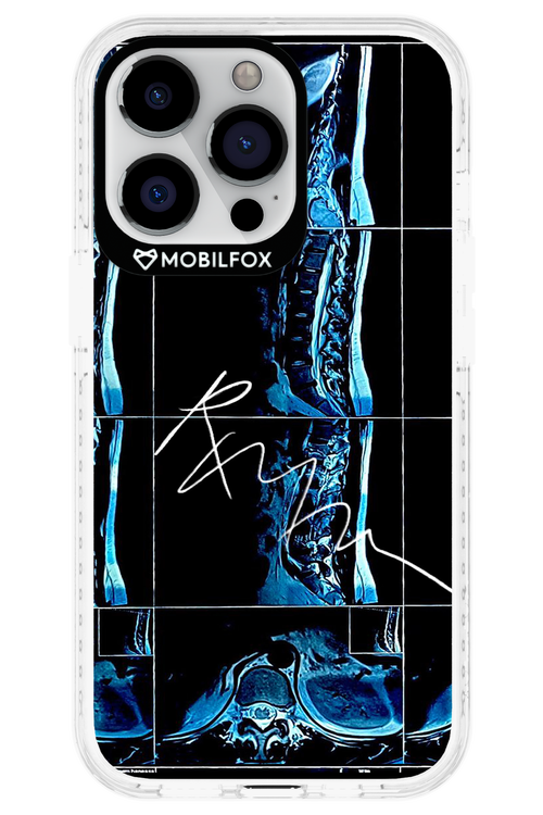 RMN Scolioza 2.0 - Apple iPhone 13 Pro