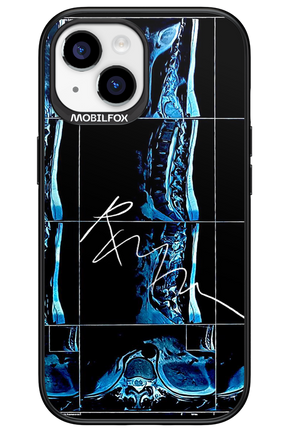 RMN Scolioza 2.0 - Apple iPhone 15