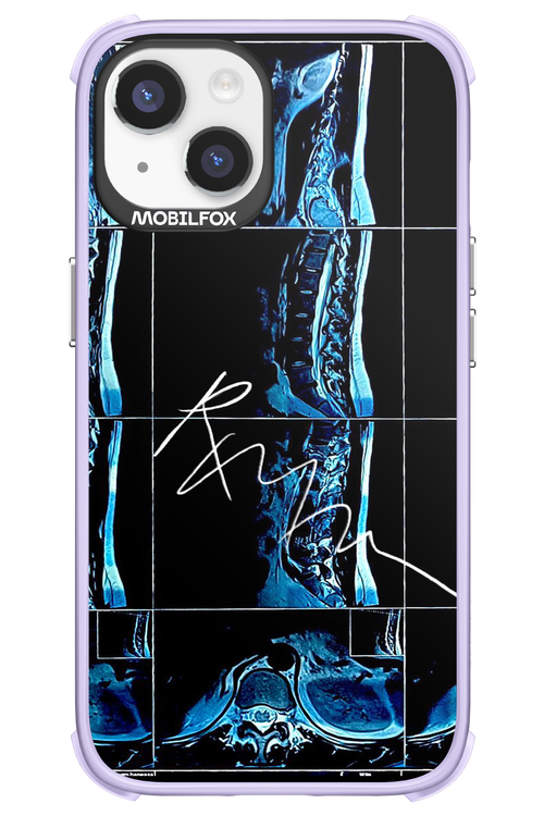 RMN Scolioza 2.0 - Apple iPhone 14