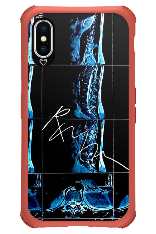 RMN Scolioza 2.0 - Apple iPhone X