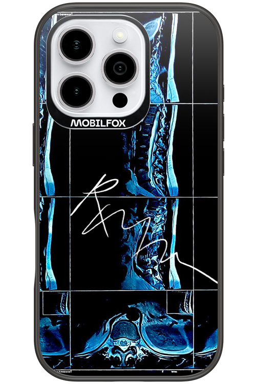 RMN Scolioza - Apple iPhone 16 Pro