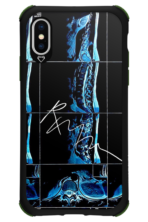 RMN Scolioza 2.0 - Apple iPhone XS