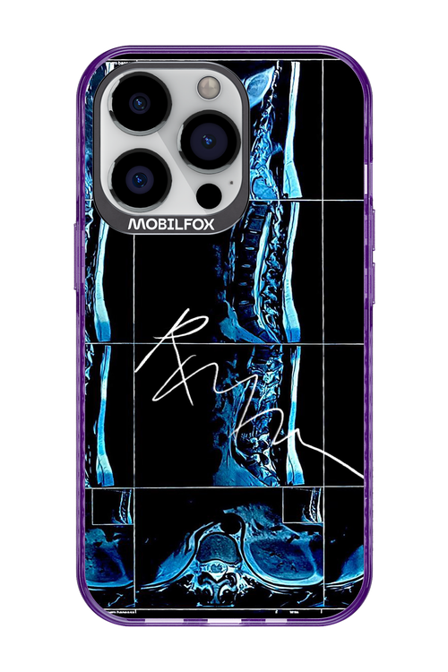 RMN Scolioza 2.0 - Apple iPhone 13 Pro