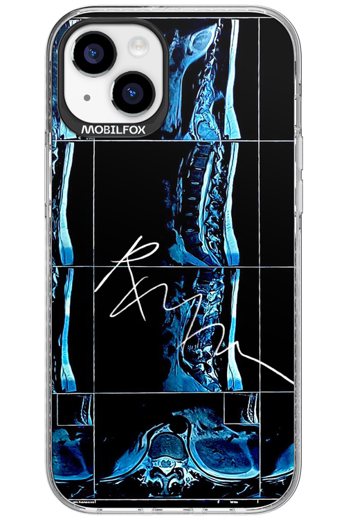 RMN Scolioza 2.0 - Apple iPhone 15 Plus