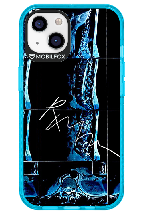 RMN Scolioza 2.0 - Apple iPhone 13