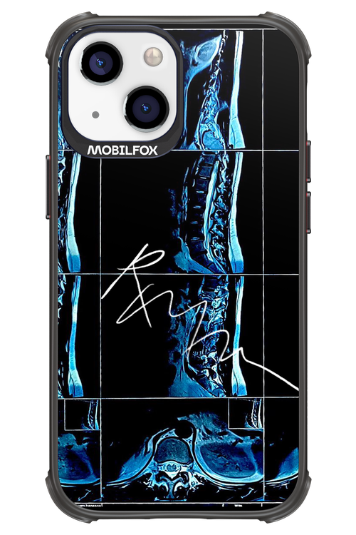 RMN Scolioza 2.0 - Apple iPhone 13 Mini