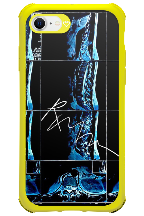 RMN Scolioza 2.0 - Apple iPhone 7
