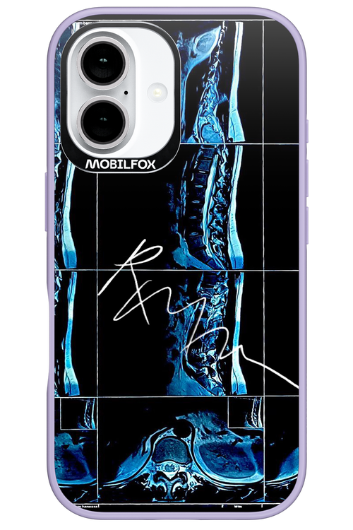 RMN Scolioza 2.0 - Apple iPhone 16