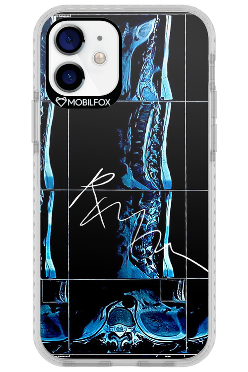 RMN Scolioza 2.0 - Apple iPhone 12