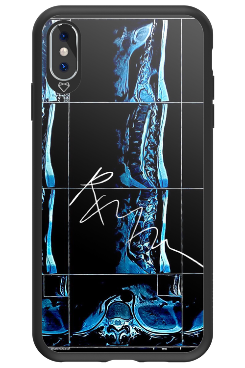 RMN Scolioza 2.0 - Apple iPhone XS Max