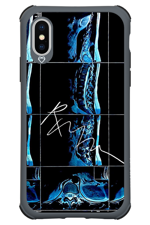 RMN Scolioza 2.0 - Apple iPhone X