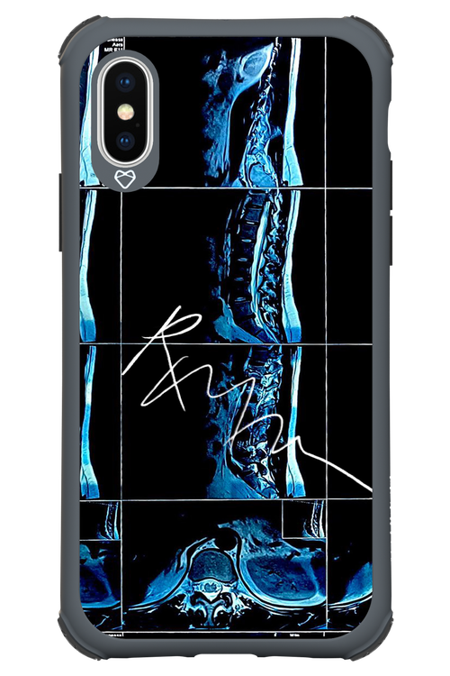 RMN Scolioza 2.0 - Apple iPhone XS