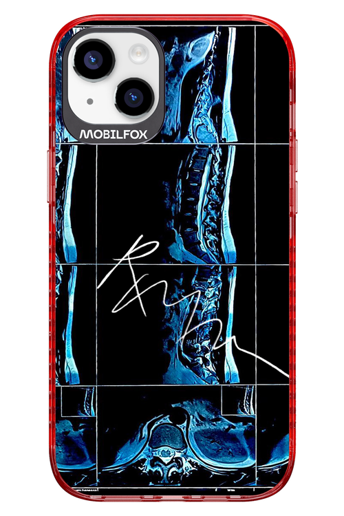 RMN Scolioza 2.0 - Apple iPhone 14 Plus