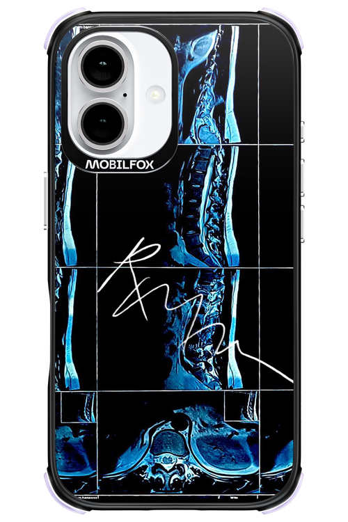 RMN Scolioza 2.0 - Apple iPhone 16