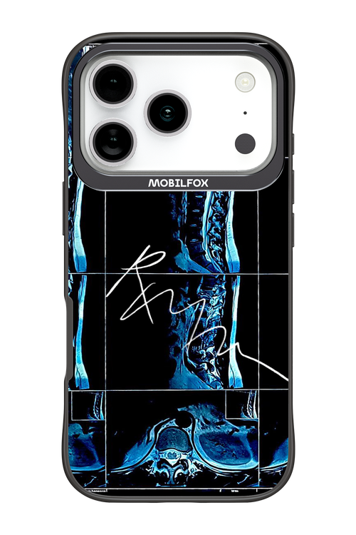 RMN Scolioza 2.0 - Apple iPhone 17 Pro