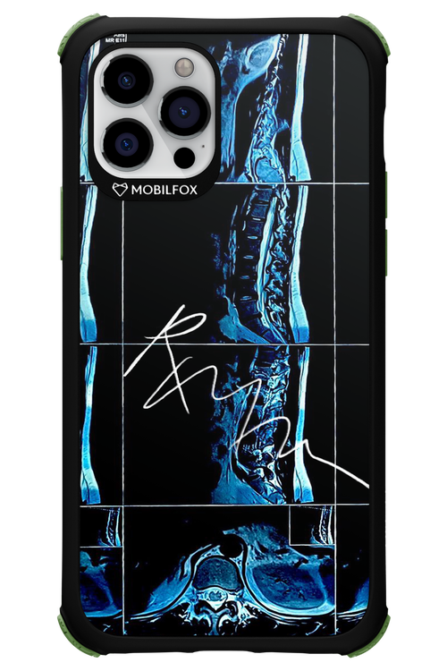 RMN Scolioza 2.0 - Apple iPhone 12 Pro