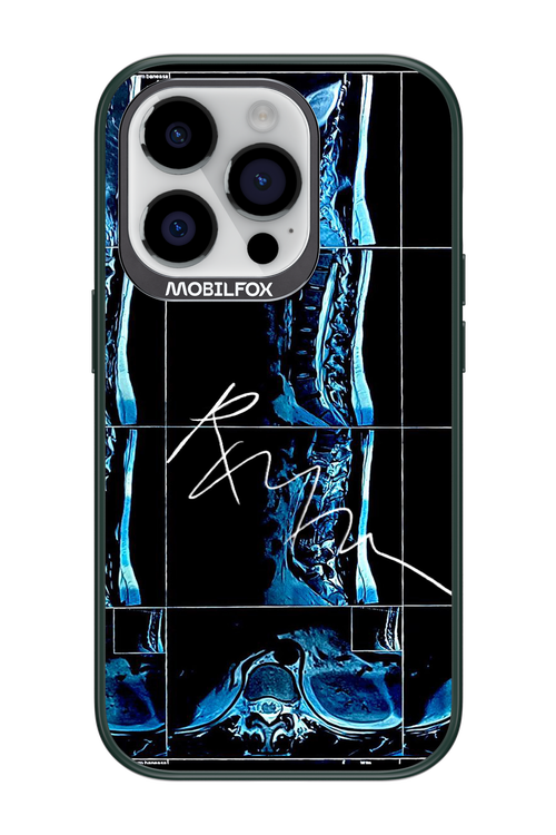 RMN Scolioza 2.0 - Apple iPhone 14 Pro