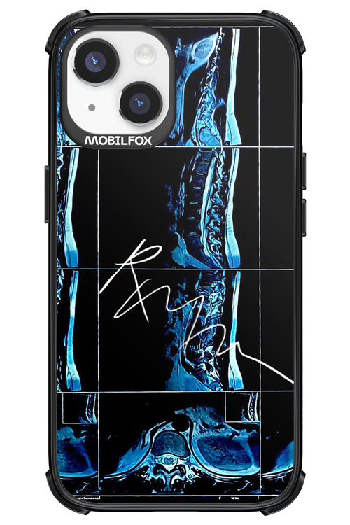 RMN Scolioza 2.0 - Apple iPhone 14