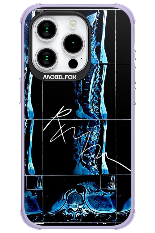 RMN Scolioza 2.0 - Apple iPhone 15 Pro