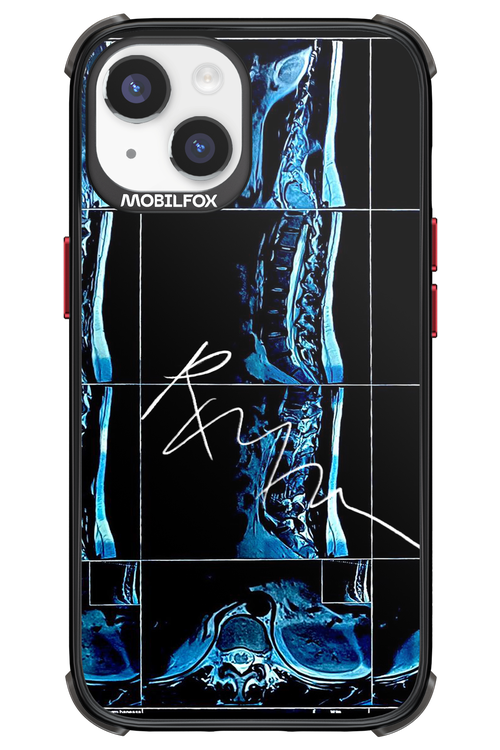 RMN Scolioza 2.0 - Apple iPhone 14