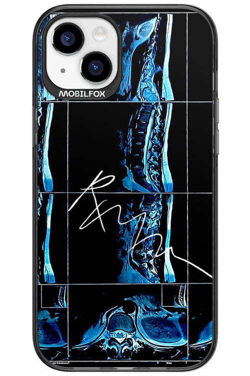 RMN Scolioza 2.0 - Apple iPhone 15 Plus