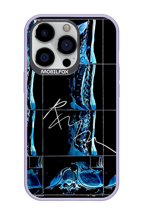 RMN Scolioza 2.0 - Apple iPhone 13 Pro