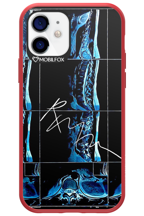 RMN Scolioza 2.0 - Apple iPhone 12