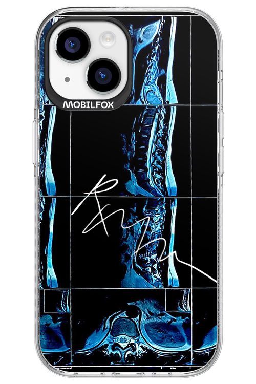 RMN Scolioza 2.0 - Apple iPhone 15