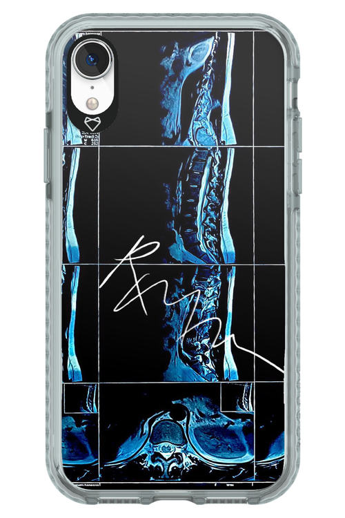 RMN Scolioza 2.0 - Apple iPhone XR