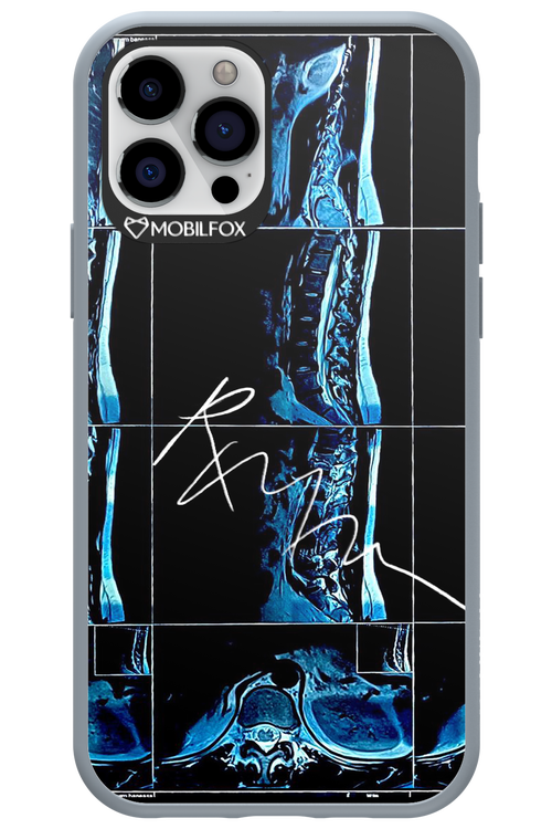 RMN Scolioza 2.0 - Apple iPhone 12 Pro