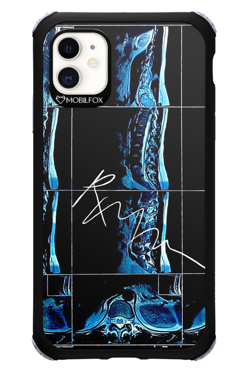 RMN Scolioza 2.0 - Apple iPhone 11