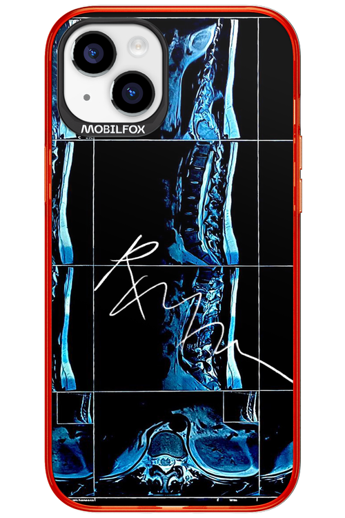 RMN Scolioza 2.0 - Apple iPhone 15 Plus