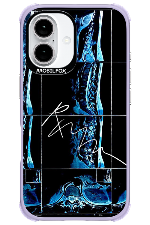 RMN Scolioza 2.0 - Apple iPhone 16