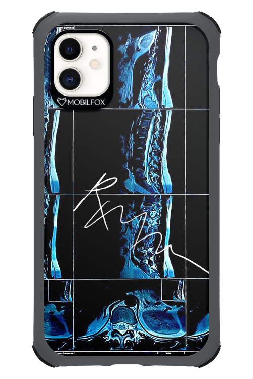 RMN Scolioza 2.0 - Apple iPhone 11