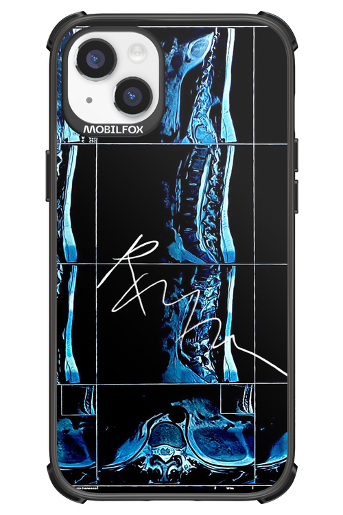 RMN Scolioza 2.0 - Apple iPhone 14 Plus