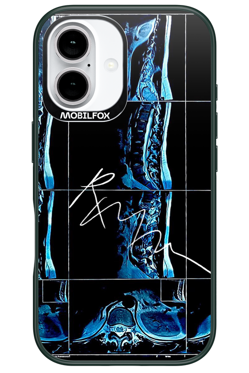 RMN Scolioza 2.0 - Apple iPhone 16