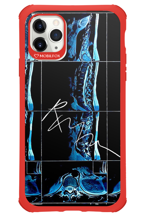 RMN Scolioza 2.0 - Apple iPhone 11 Pro Max