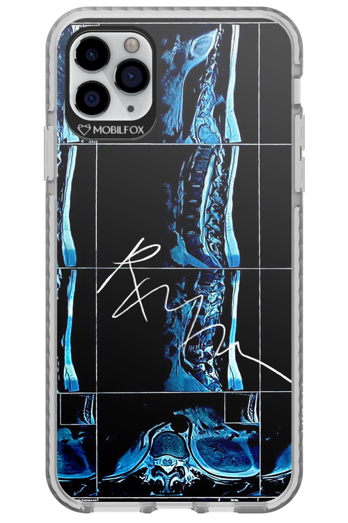 RMN Scolioza 2.0 - Apple iPhone 11 Pro Max
